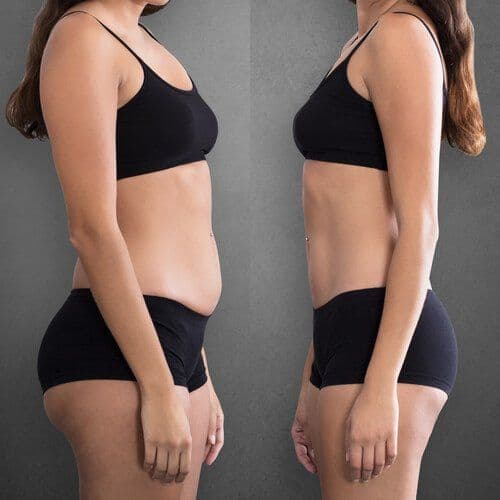 Liposuction Surgery Before After