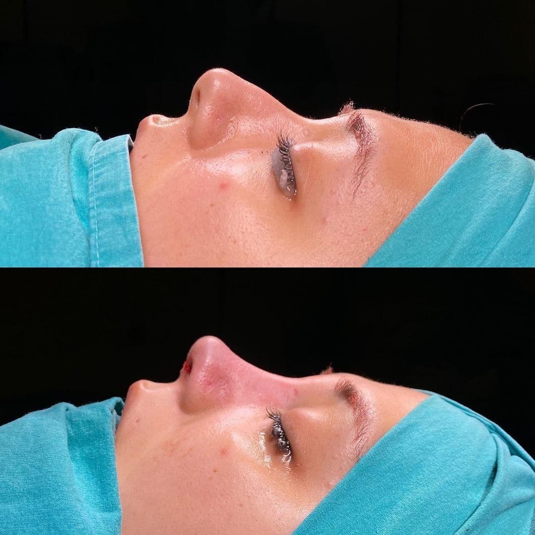 Women Rhinoplasty Before After