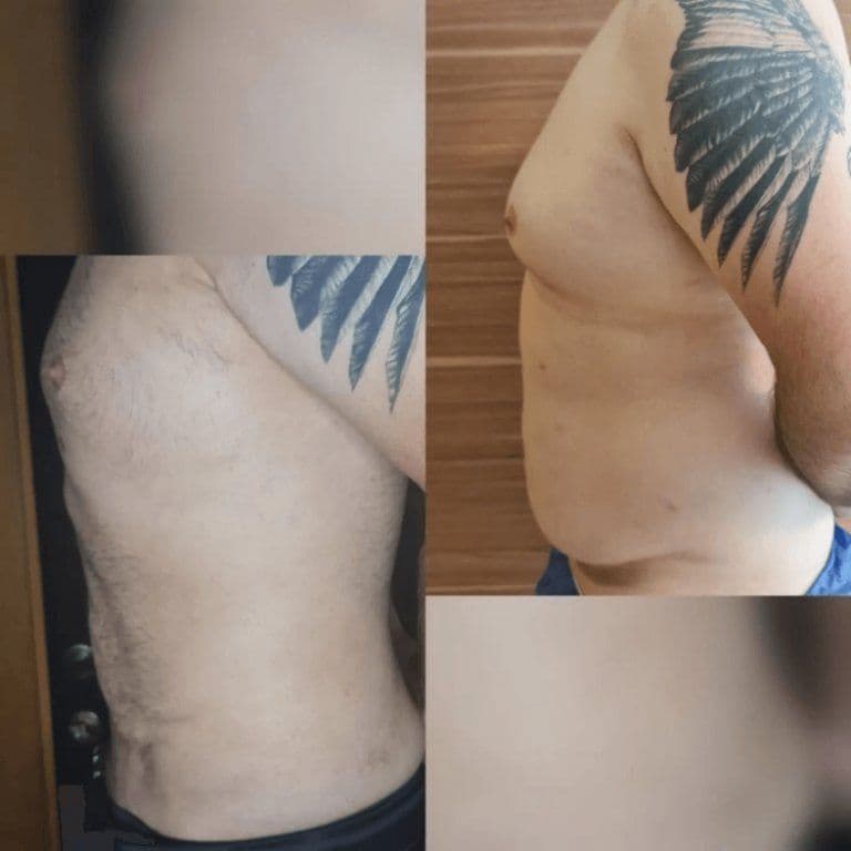 Lipo Surgerys Before After