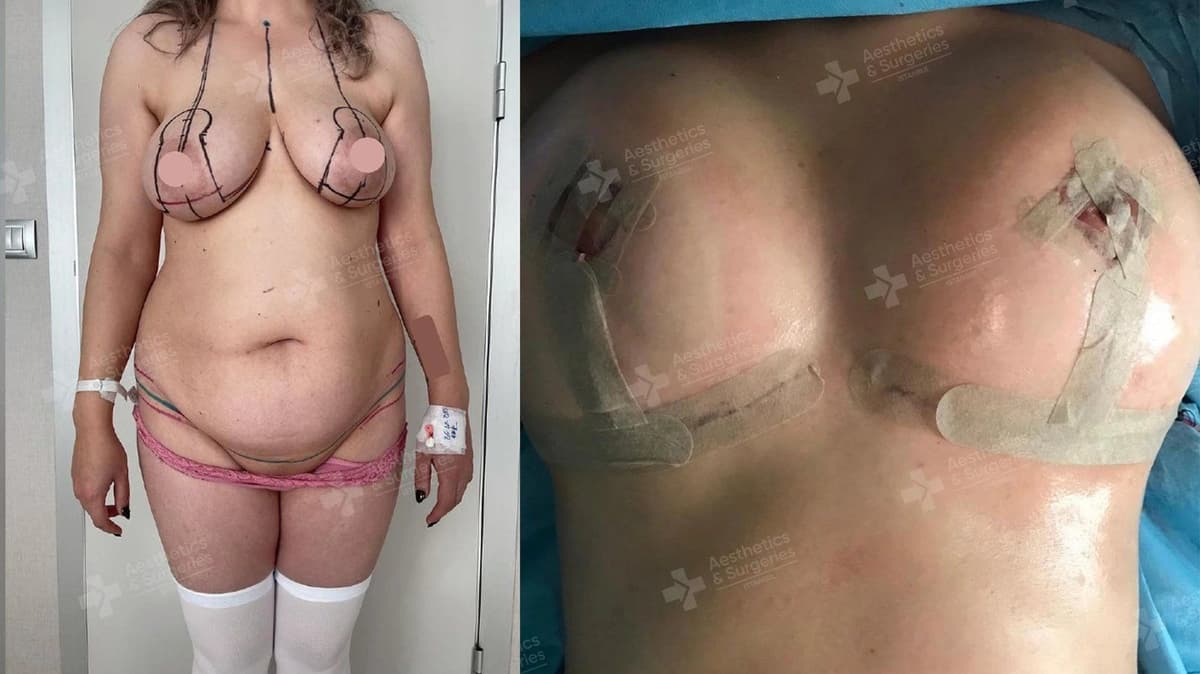 Augmentation mammaire à Istanbul : Types d'implants, coûts et guide de récupération