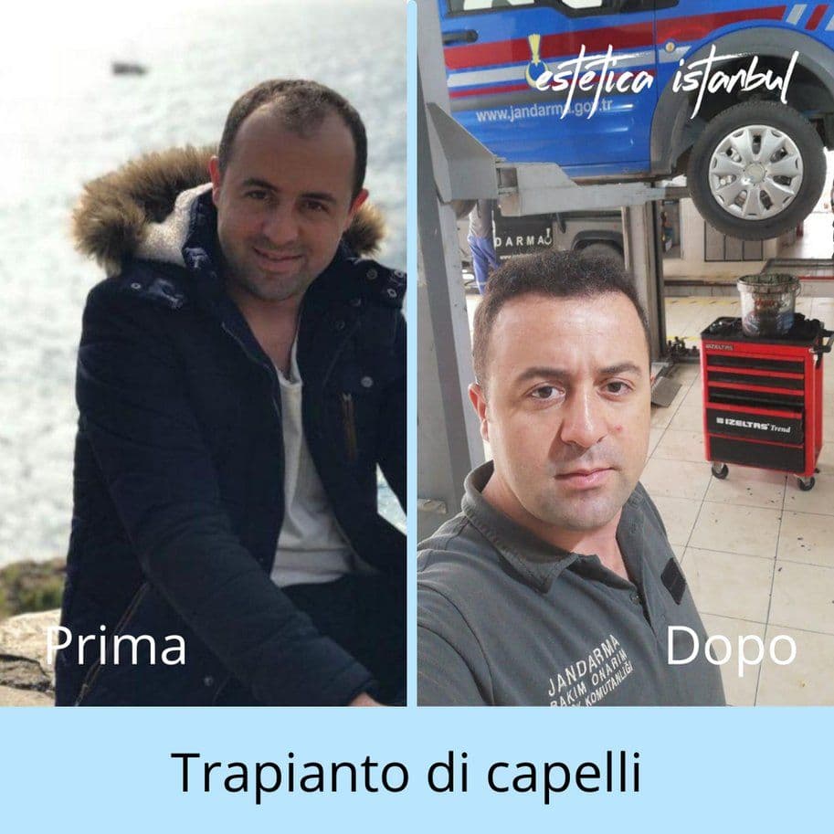 Hair Transplant Before After 07