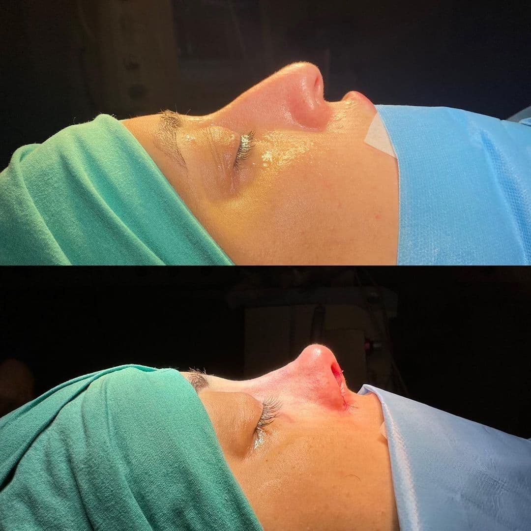 Lifting facciale pasticciato: cosa devi sapere prima dell'intervento chirurgico