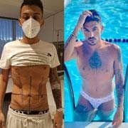 Estetica Body Lift Surgery Before Afterk