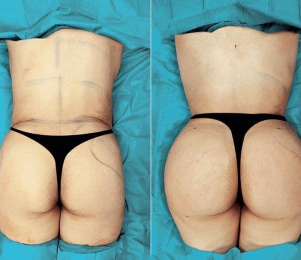 Bbl Before After In Turkey 2