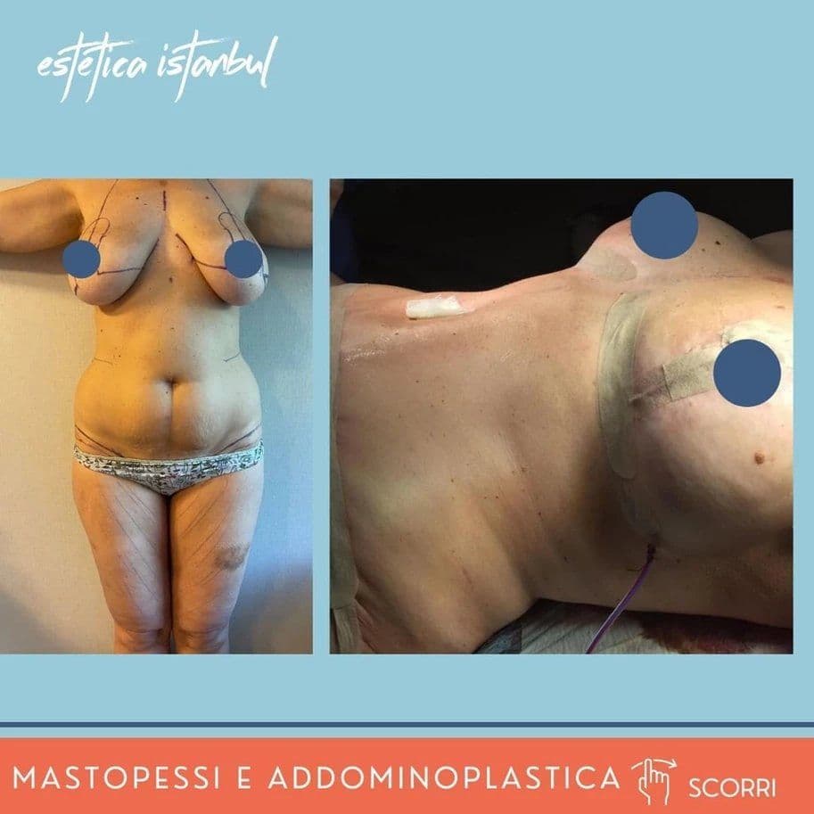 Tummy Tuck Before After 07