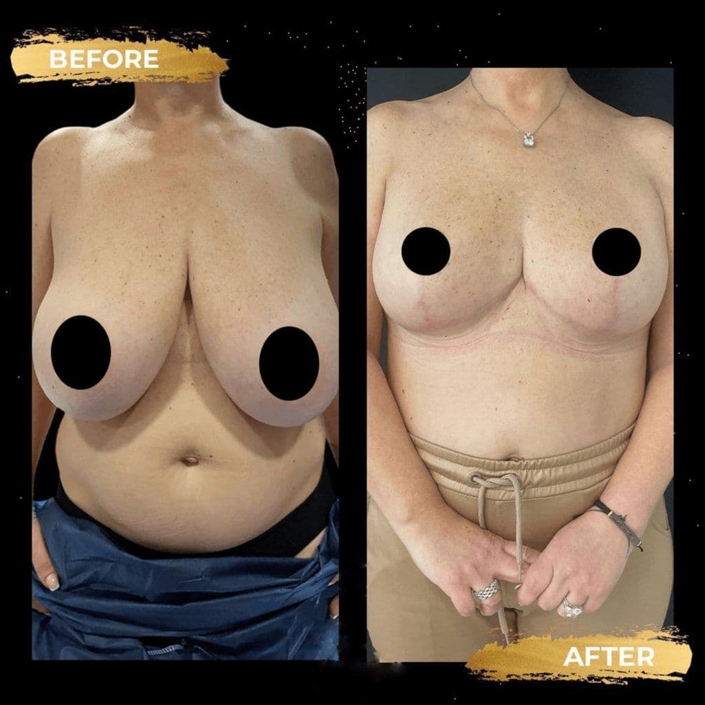 Breast Reduction Surgery Before And After