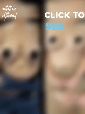 Breast Before After Eng 8