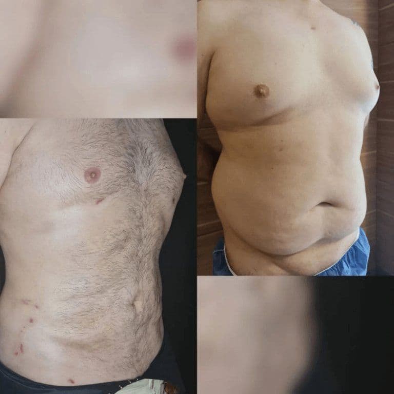 Lipo Surgery Before After