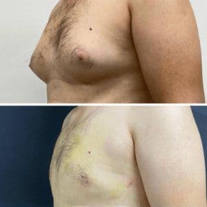 Gynecomastia Before And After Istanbul