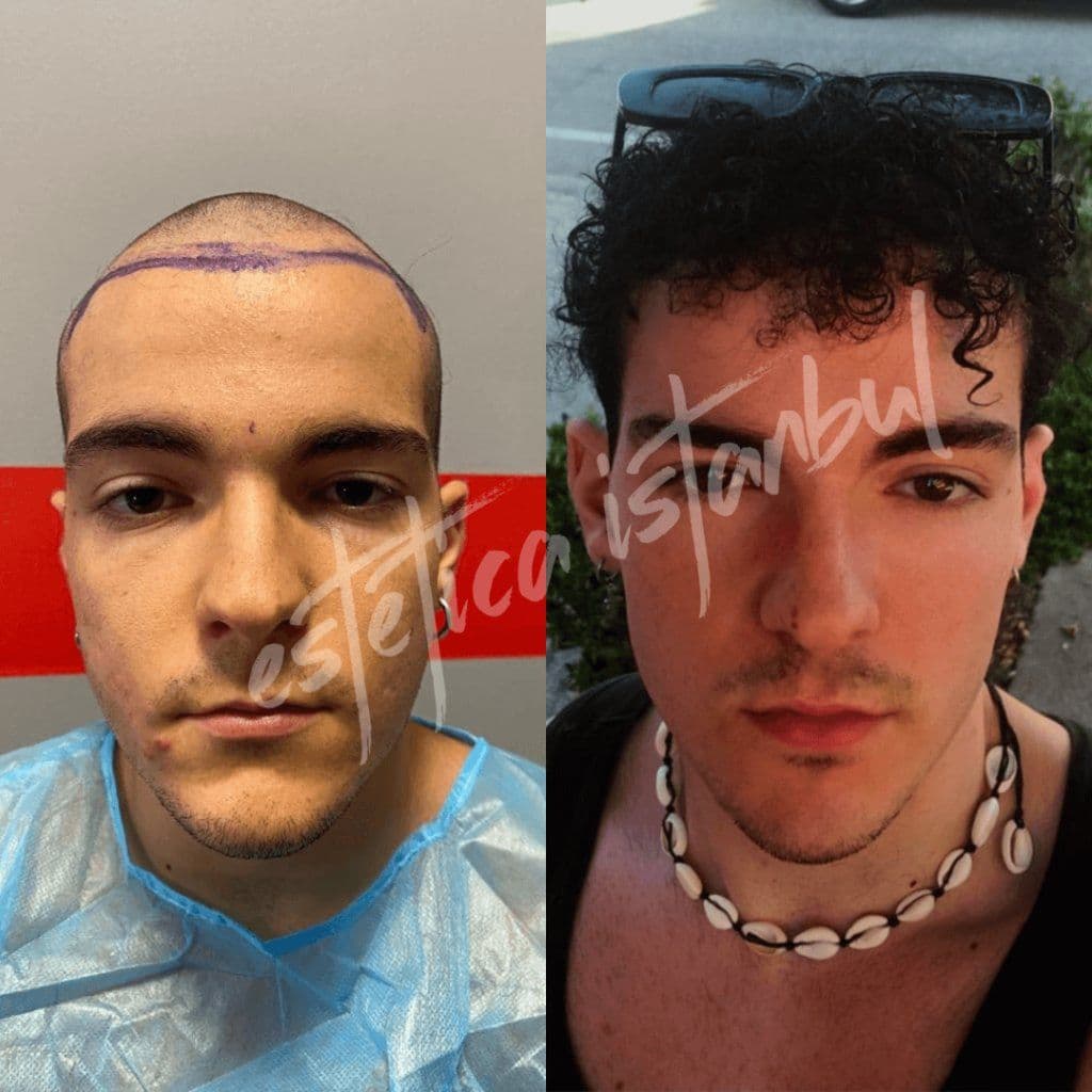 Combien coûte une greffe de cheveux à Istanbul ? Guide des prix 2026