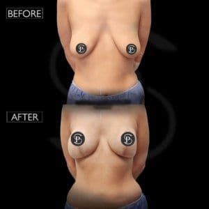 Breast Lift Before After In Turkey
