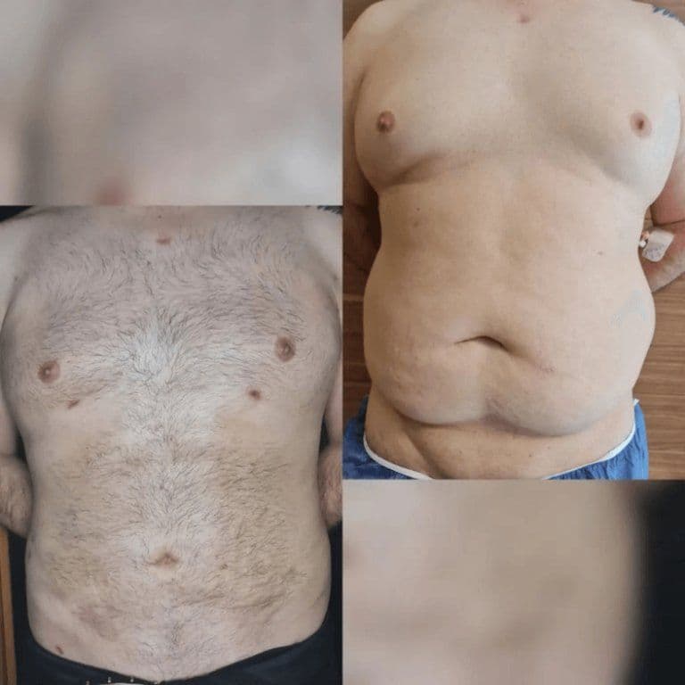 Lipo Surgery Before And After Turkey